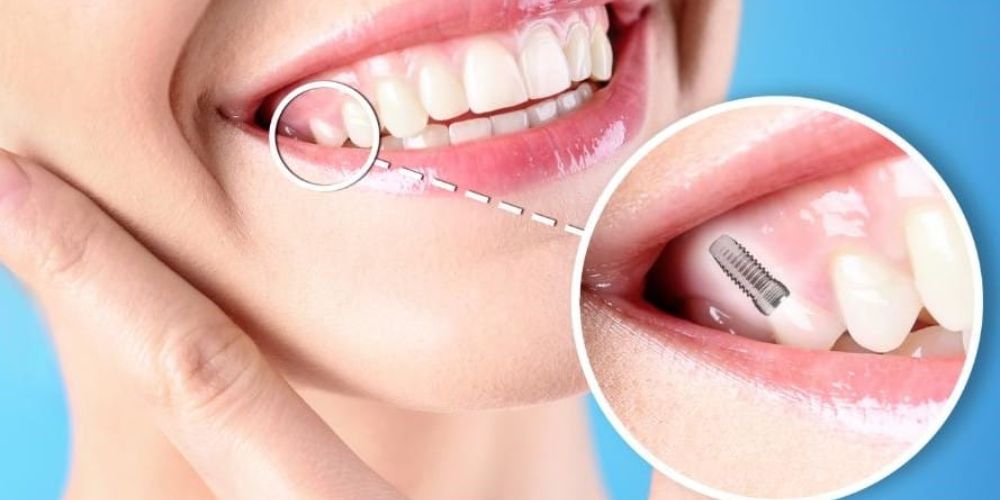 What Does an Implantologist Do? Understanding Dental Implant Treatment