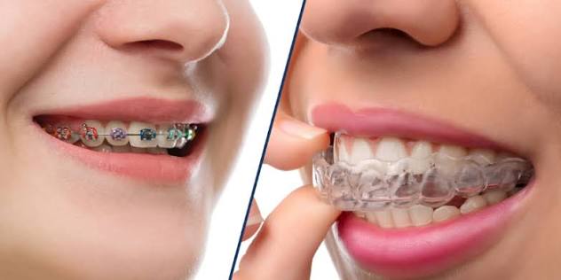 Braces vs Clear Aligners: Which Is Better for Your Smile?